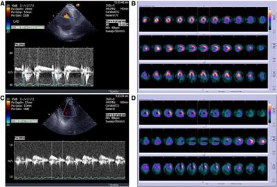 Predictors of diastolic deceleration time of coronary flow velocity of infarct related and reference coronary artery assessed by transthoracic Doppler echocardiography in the chronic phase of successfully reperfused anterior myocardial infarction: relation to infarct size